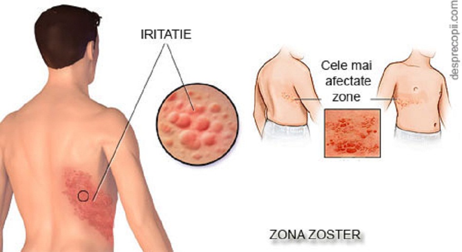 Poza cu zona zoster anim1